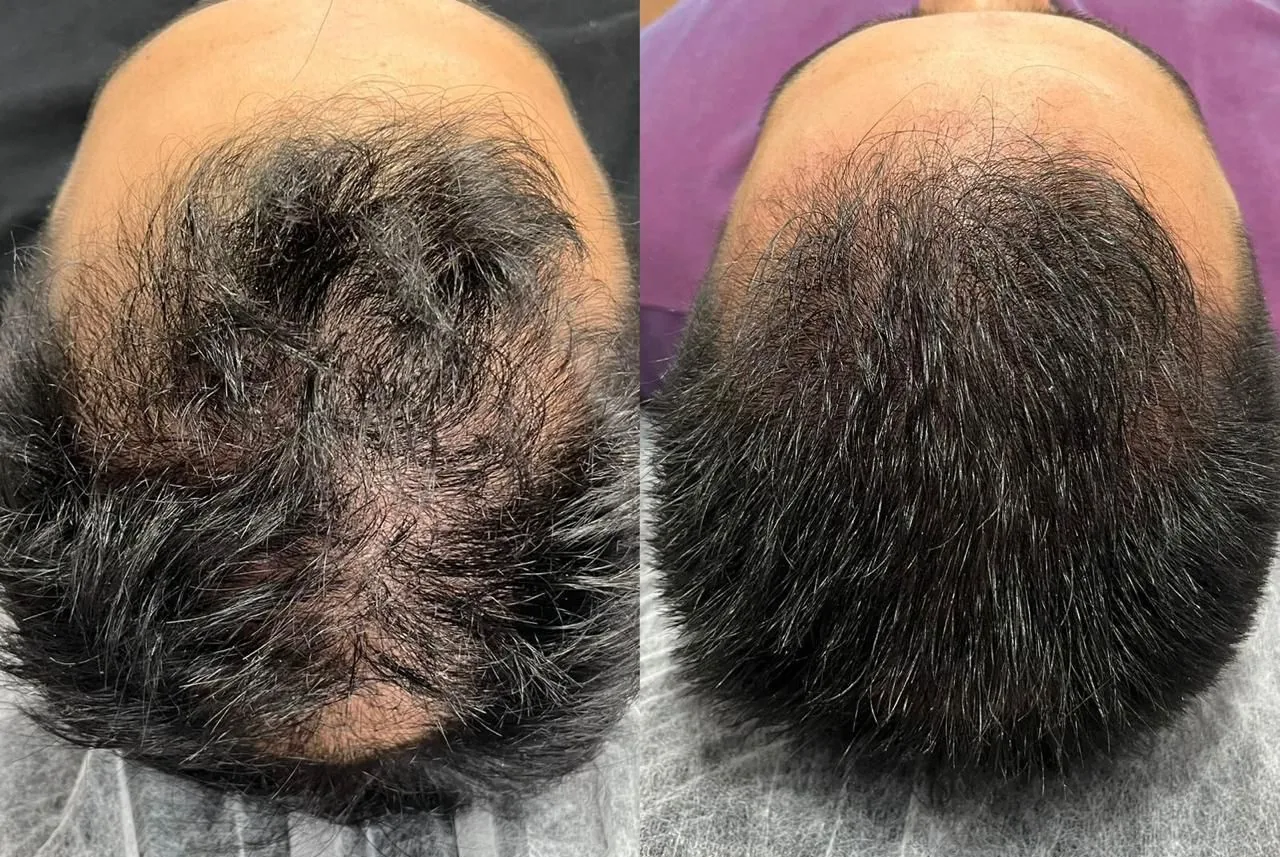 Comparação de rarefação na coroa antes e depois de protocolo capilar em Palhoça
