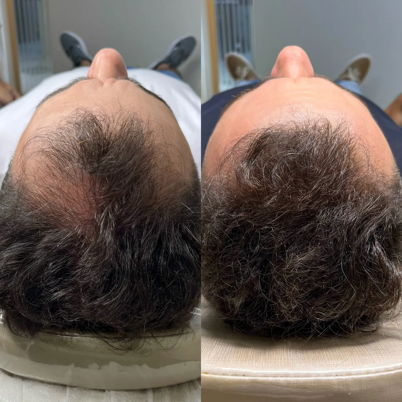 Comparação de afinamento no topo antes e depois de protocolo capilar em Palhoça